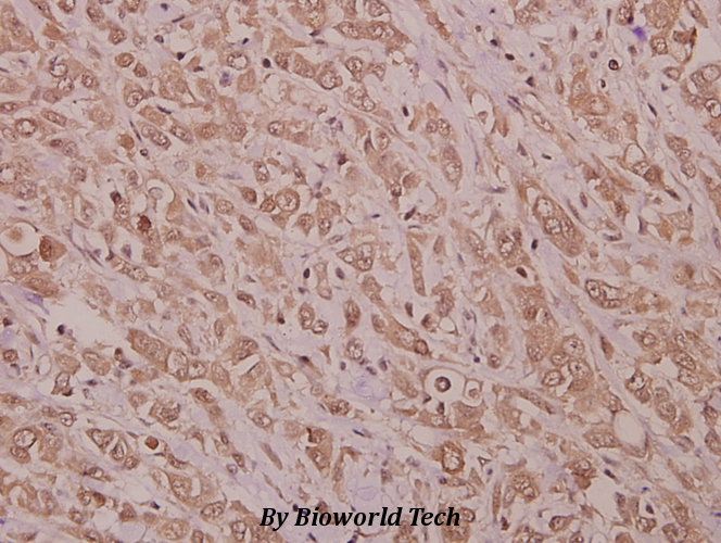 Immunohistochemistry (IHC) analyzes of STK33 (N108) pAb in paraffin-embedded human colorectal carcinoma tissue at 1:50.