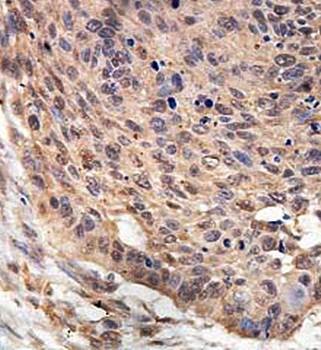  Immunohistochemical analysis of formalin-fixed paraffin embedded oesophageal carcinoma staining using ARMCX5 antibody
