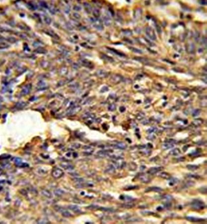  Immunohistrochemical analysis of formalin-fixed and paraffin-embedded human lung carcinoma tissue using HBA2 antibody
