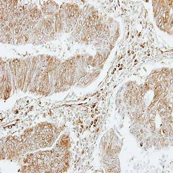  Immunohistochemical analysis of formalin-fixed and paraffin-embedded Colon ca using platelet factor 4 variant 1 antibody 