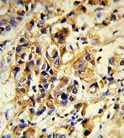 Immunohistrochemical analysis of formalin-fixed and paraffin-embedded human breast carcinoma tissue using RPGRIP1 antibody 