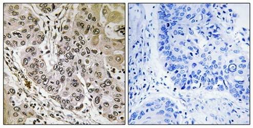  Immunohistochemical analysis of formalin-fixed and paraffin-embedded human lung carcinoma tissue using STK36 antibody