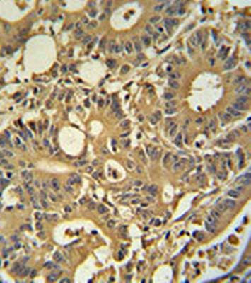  Immunohistochemical analysis of formalin fixed and paraffin embedded human colon carcinoma tissue using TPSD1 antibody