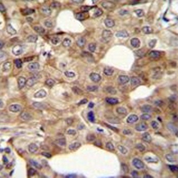  Immunohistochemical analysis of formalin-fixed paraffin embedded human breast carcinoma tissue using CCNI2 antibody (Center) 