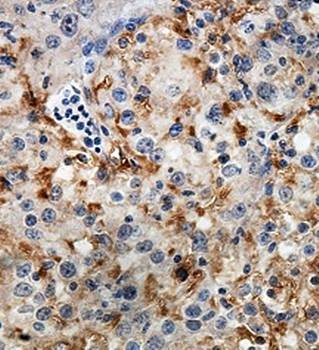  Immunohistochemical analysis of formalin-fixed paraffin embedded kidney carcinoma staining using PNLIPRP1 antibody