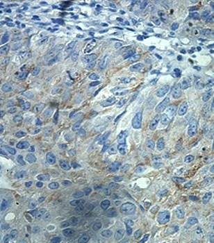 Immunohistochemical analysis of formalin-fixed paraffin embedded uriinary bladder carcinoma showing cytoplasmic staining using FGD5 antibody 