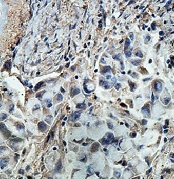 Immunohistochemical analysis of formalin-fixed paraffin embedded lung carcinoma showing cytoplasmic and membrane staining using ARHGAP27 antibody 