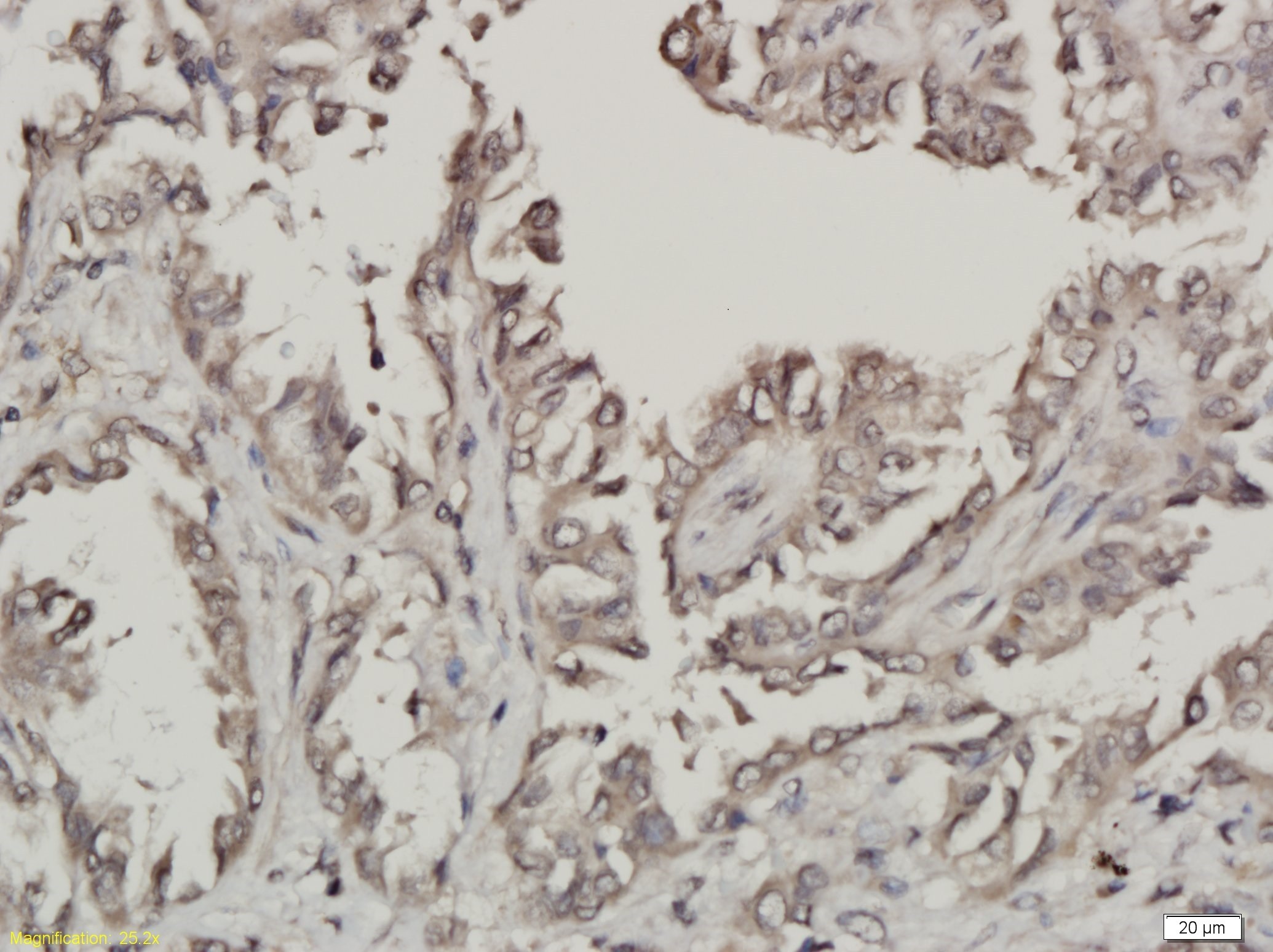  IHC-P from different cancer patients(Adenocarcinoma). 