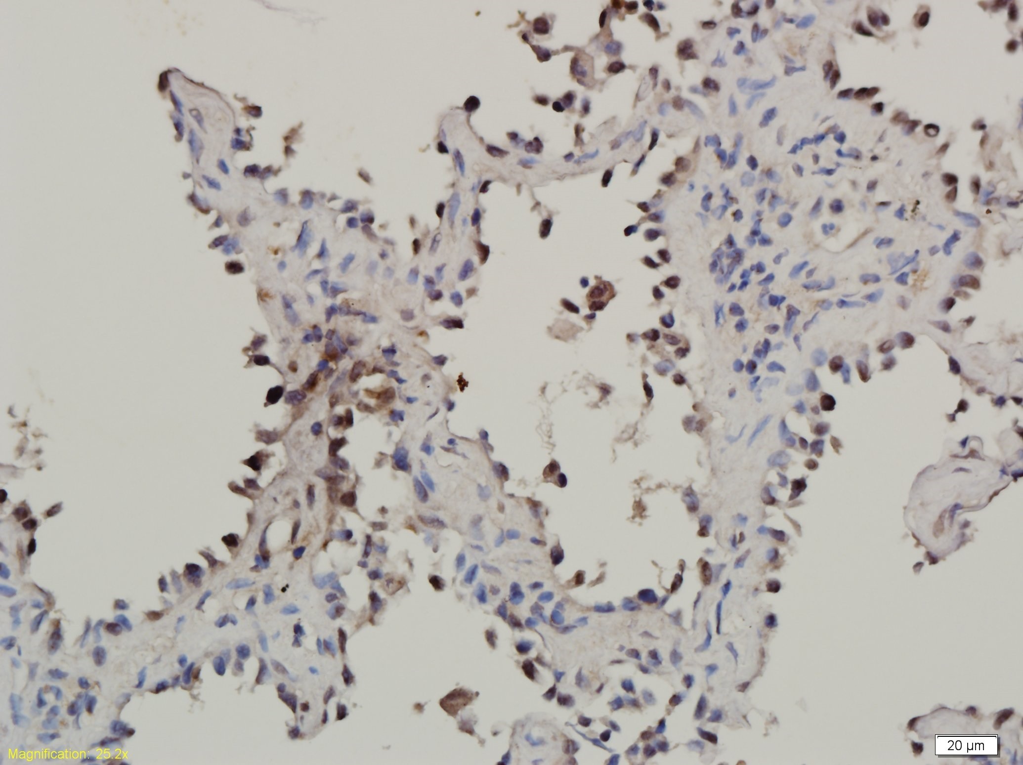  IHC-P from different cancer patients(Adenocarcinoma). 