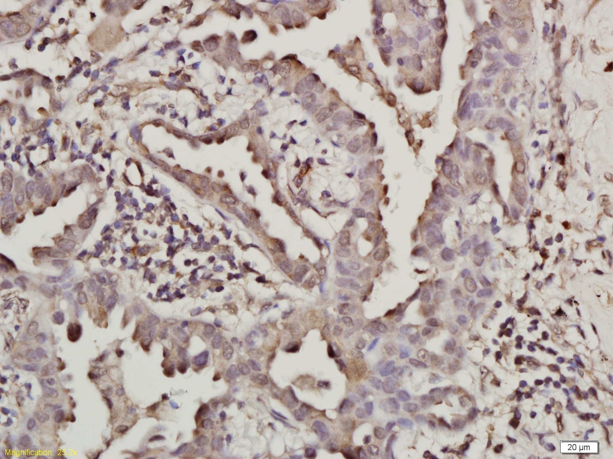  IHC-P from different cancer patients(Adenocarcinoma).