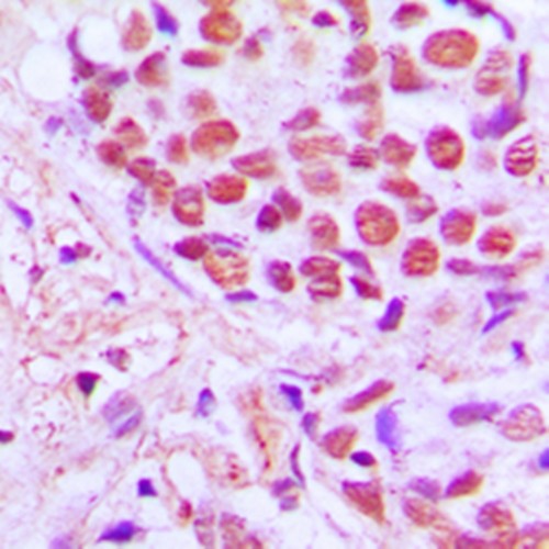  Immunohistochemical analysis of formalin-fixed and paraffin-embedded human breast cancer tissue using SRSF4 antibody (dilution at 1:200)