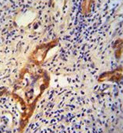 Immunohistochemical analysis of formalin fixed and paraffin embedded human hepatocarcinoma tissue using CLPX antibody 