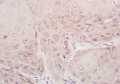 Immunohistochemical analysis of formalin-fixed paraffin embedded human laryngocarcinoma tissue using DSPP antibody (dilution at 1:200)