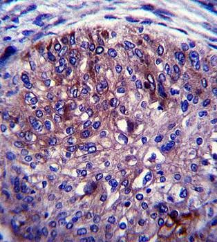 Immunohistochemical analysis of formalin fixed and paraffin embedded human esophagus carcinoma tissue using ADAL antibody 