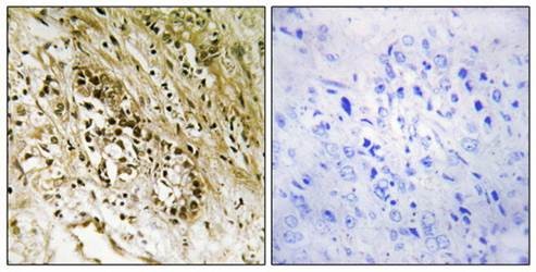 Immunohistochemical analysis of formalin-fixed and paraffin-embedded human prostate carcinoma tissue using PDZD2 antibody 