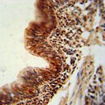  Immunohistochemical analysis of formalin-fixed paraffin embedded human lung carcinoma tissue using RBM43 antibody (N-term) 