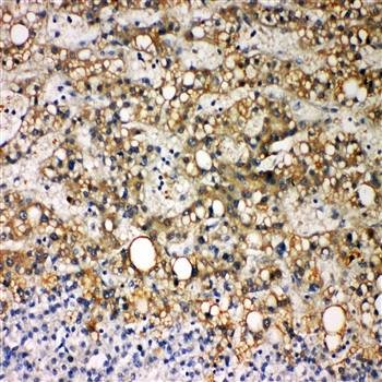  Immunohistochemical analysis of formalin-fixed paraffin embedded Human Liver Cancer Tissue using CYP7A1 antibody