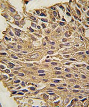 Immunohistochemical analysis of formalin-fixed and paraffin-embedded human lung carcinoma tissue using ALDOA antibody