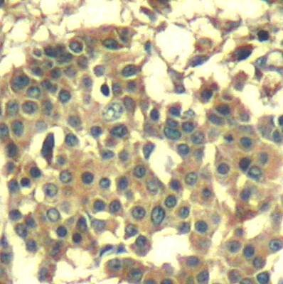 Immunohistochemical analysis of formalin-fixed and paraffin-embedded human breast carcinoma tissue using Met(Ab-1003) antibody 