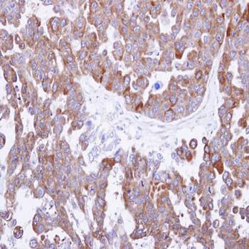  Immunohistochemical analysis of formalin-fixed and paraffin-embedded OVCAR3 xenograft using TCP 1 theta antibody