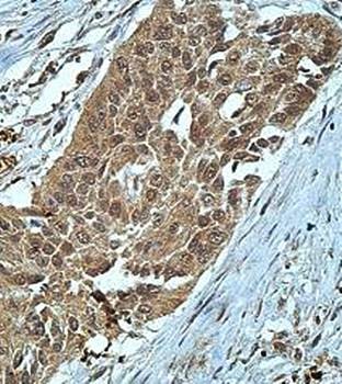 Immunohistochemical analysis of formalin-fixed paraffin embedded esophageal cancer showing nuclear staining using PPAN antibody 