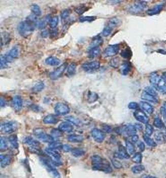  Immunohistochemical analysis of formalin-fixed paraffin embedded colon carcinoma showing cytoplasmic staining using SGSM3 antibody