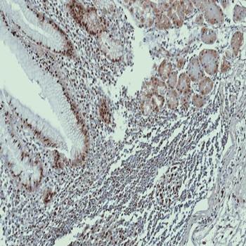  Immunohistochemical analysis of formalin-fixed and paraffin-embedded gastric CA using DDX39 antibody 