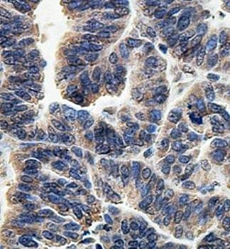  Immunohistochemical analysis of formalin-fixed paraffin embedded ovary carcinoma showing cytoplasmic staining using LRRC46 antibody