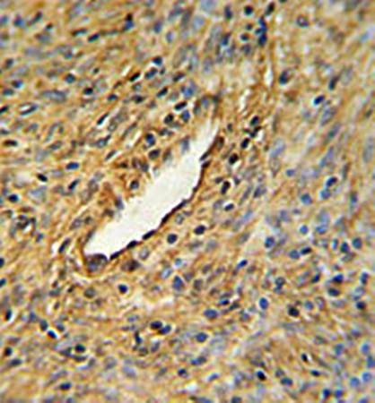  Immunohistrochemical analysis of formalin fixed and paraffin embedded prostate carcinoma tissue using CEP63 antibody