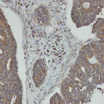  Immunohistochemical analysis of formalin-fixed and paraffin-embedded endo mitral OVCA using PPM1K antibody