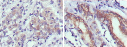 Immunohistochemical analysis of paraffin-embedded human gastric cancer (left) and normal gastric tissues (right) using CER1 antibody 