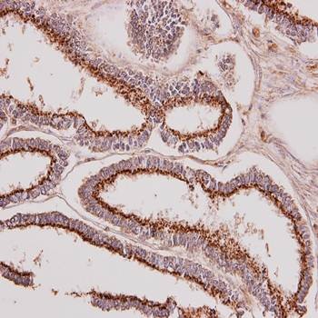 Immunohistochemical analysis of formalin-fixed and paraffin-embedded Endometrial CA using GALNT7 antibody