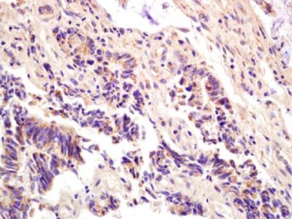IHC-P of human rectal carcinoma tissue using ompF (dilution at 1:200)