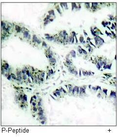 Immunohistochemical analysis of paraffin-embedded human lung carcinoma tissue, using Akt (phospho-Thr308) antibody