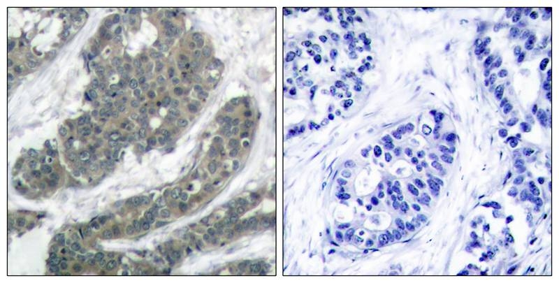 ARG51242 anti-p62 Dok antibody IHC-P image Immunohistochemistry: paraffin-embedded human breast carcinoma tissue stained with anti-p62Dok antibody ARG51242 (left) or the same antibody preincubated with blocking peptide (right).