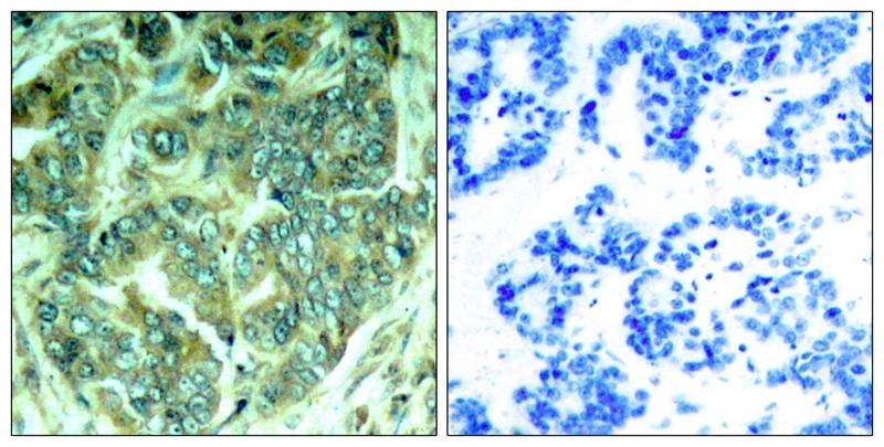 ARG51758 anti-p62 Dok phospho (Tyr398) antibody IHC-P image Immunohistochemistry: paraffin-embedded human breast carcinoma tissue stained with anti-p62Dok (phospho Tyr398) antibody ARG51758 (left) or the same antibody preincubated with blocking peptide (right).