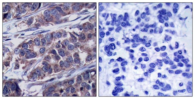 ARG51757 anti-p62 Dok phospho (Tyr362) antibody IHC-P image Immunohistochemistry: paraffin-embedded human breast carcinoma tissue stained with anti-p62Dok (phospho Tyr362) antibody ARG51757 (left) or the same antibody preincubated with blocking peptide (right).