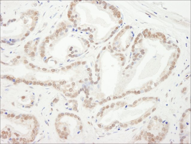 <B>Immunohistochemistry</B><BR/>Rabbit Anti-CBX5 Antibody, Affinity Purified: <B>Cat. No. PLA0150</B>: Detection of Human CBX5 by Immunohistochemistry. Sample: FFPE section of Human prostate carcinoma. Antibody: Affinity purified Rabbit Anti-CBX5 (<B>Cat. No. PLA0150</B>) used at a dilution of 1:5,000 (0.2 μg/mL). Detection: DAB staining.
