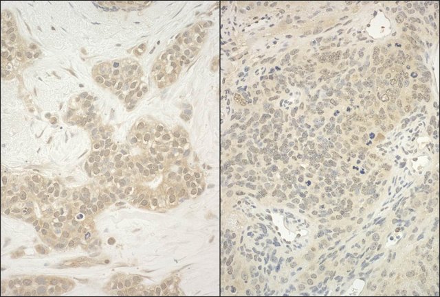<B>Immunohistochemistry</B><BR/>Rabbit Anti-YY1 Antibody, Affinity Purified: <B>Cat. No. PLA0268</B>: Detection of Human and Mouse YY1 by Immunohistochemistry. Sample: FFPE section of Human breast carcinoma (left) and Mouse teratoma (right). Antibody: Affinity purified Rabbit Anti-YY1 (<B>Cat. No. PLA0268</B>) used at a dilution of 1:200 (1 μg/mL). Detection: DAB