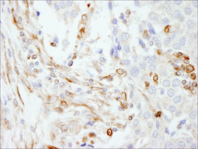 <B>Immunohistochemistry</B><BR/>Rabbit Anti-Vimentin Antibody, Affinity Purified: <B>Cat. No. PLA0199</B>: Detection of Human Vimentin by Immunohistochemistry. Sample: FFPE section of Human breast carcinoma. Antibody: Affinity purified Rabbit Anti-Vimentin (<B>Cat. No. PLA0199</B>) used at a dilution of 1:200 (1 μg/mL). Detection: DAB