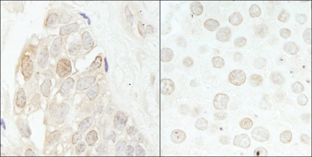 <B>Immunohistochemistry</B><BR/>Rabbit Anti-CDK2 Antibody, Affinity Purified: <B>Cat. No. PLA0213</B>: Detection of Human and Mouse CDK2 by Immunohistochemistry. Sample: FFPE section of Human breast carcinoma (left) and Mouse renal cell carcinoma (right). Antibody: Affinity purified Rabbit Anti-CDK2 (<B>Cat. No. PLA0213</B>) used at a dilution of 1:1,000 (1 μg/mL) and 1:5,000 (0.2 μg/mL). Detection: DAB staining.