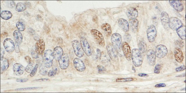 <B>Immunohistochemistry</B><BR/>Rabbit Anti-Sin1 Antibody, Affinity Purified: <B>Cat. No. PLA0157</B>: Detection of Human Sin1 by Immunohistochemistry. Sample: FFPE section of Human prostate carcinoma. Antibody: Affinity purified Rabbit Anti-Sin1 (<B>Cat. No. PLA0157</B>) used at a dilution of 1:1,000 (1 μg/mL). Detection: DAB