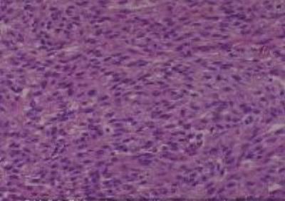 Hematoxylin & Eosin Stain: Human Melanoma Tissue MicroArray (Malignant) [NBP2-30285] -  01. Skin, Toe Malignant Melanoma