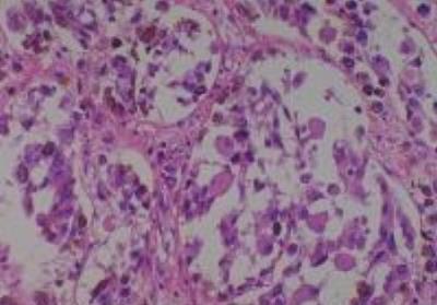 Hematoxylin & Eosin Stain: Human Melanoma Tissue MicroArray (Malignant) [NBP2-30285] - 02, SKin, hip, maligrant, malinome
