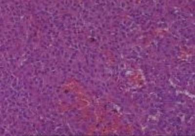 Hematoxylin & Eosin Stain: Human Melanoma Tissue MicroArray (Malignant) [NBP2-30285] -  03. Eyeball malignant melanoma
