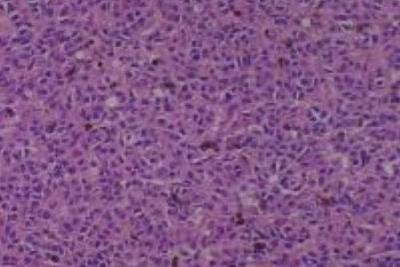 Hematoxylin & Eosin Stain: Human Melanoma Tissue MicroArray (Malignant) [NBP2-30285] -  4. Skin Malignant melanoma