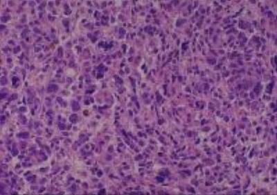 Hematoxylin & Eosin Stain: Human Melanoma Tissue MicroArray (Malignant) [NBP2-30285] - 05. Skin Hand malignant melanoma