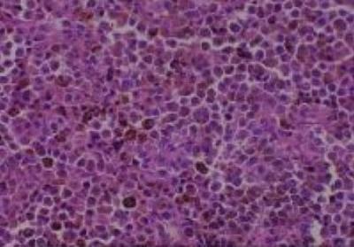 Hematoxylin & Eosin Stain: Human Melanoma Tissue MicroArray (Malignant) [NBP2-30285] - 06. Skin Neck Malignant melanoma