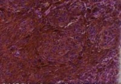 Hematoxylin & Eosin Stain: Human Melanoma Tissue MicroArray (Malignant) [NBP2-30285] -  07 elbow malignant melanoma