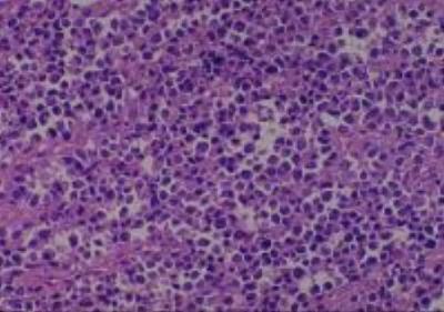 Hematoxylin & Eosin Stain: Human Melanoma Tissue MicroArray (Malignant) [NBP2-30285] -  09. Skin Abdomen Malignant Melinoma